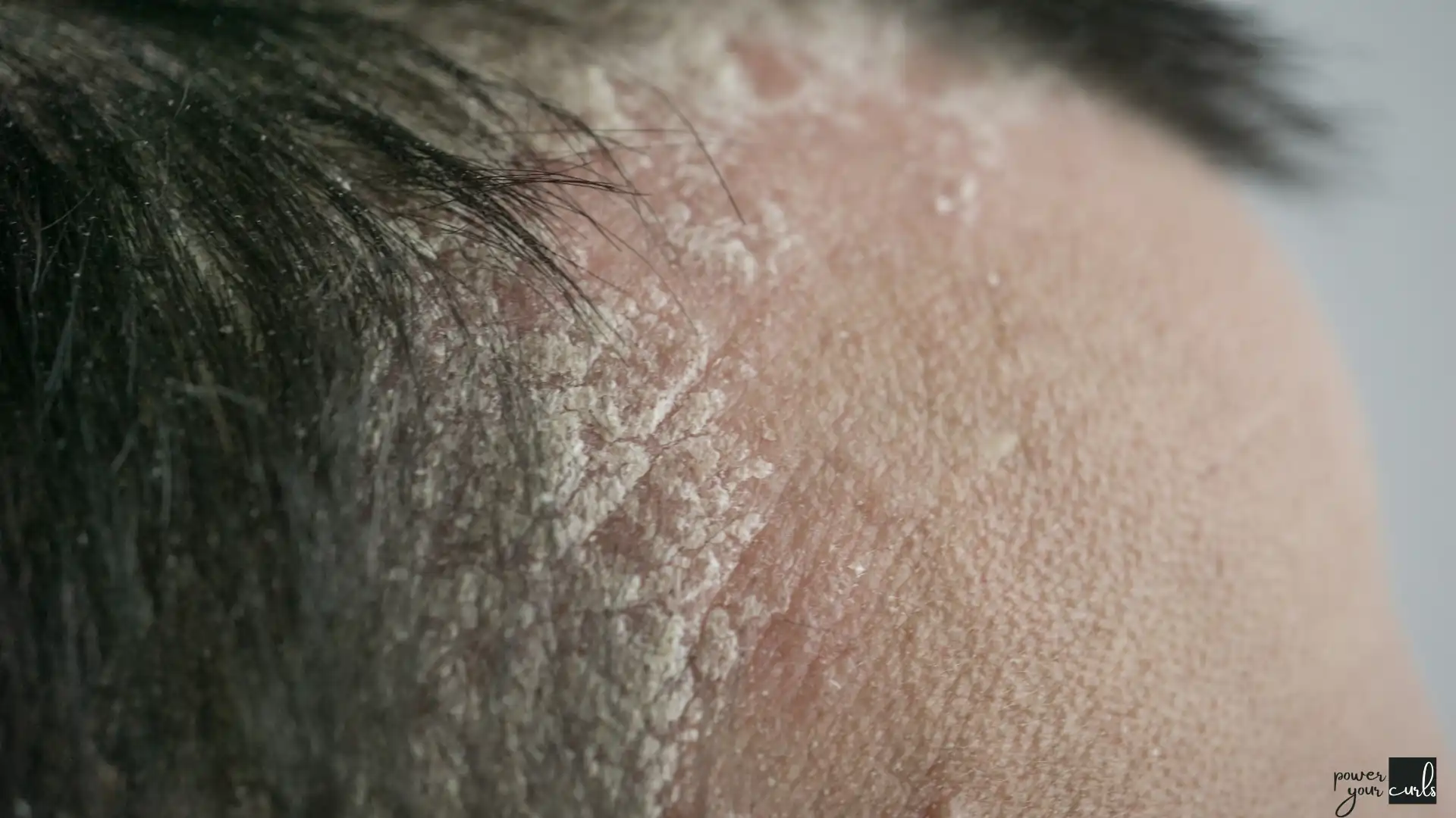 The Complete Guide To Managing Scalp Psoriasis In 2024 12 Treatment