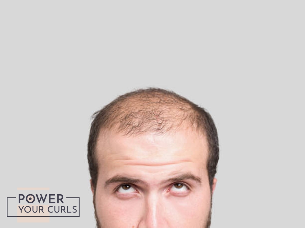 The top of a man’s head, his hair is thinning, revealing his scalp.