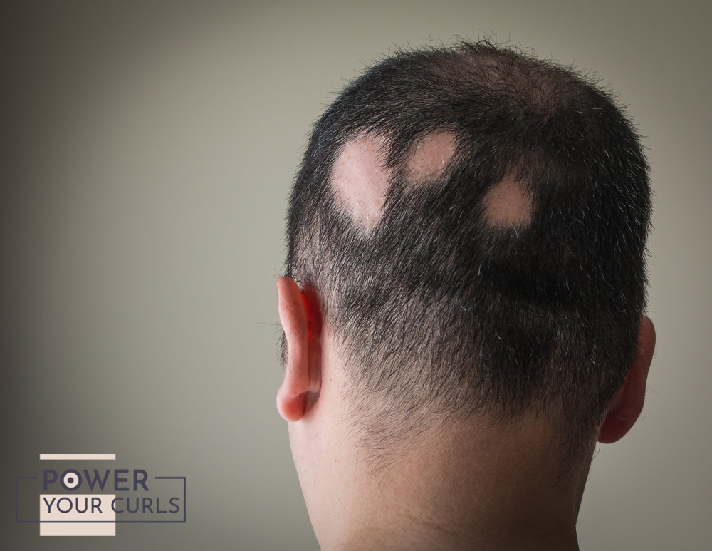 The back of a man’s head affected with alopecia areata.