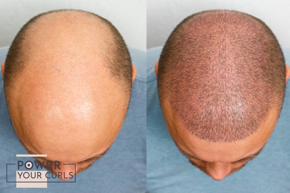 Before and after images of a hair transplant.