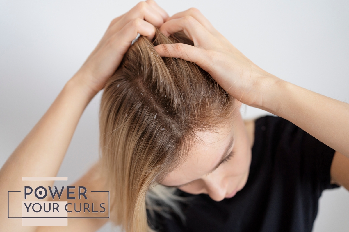 Flakes Away: What’s Flaky Scalp and How to Fix It 1 Post