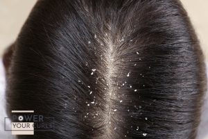 A top down view of a person’s scalp with visible dandruff.