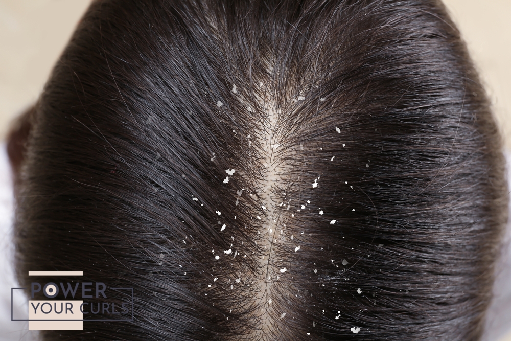 A top down view of a person’s scalp with visible dandruff.
