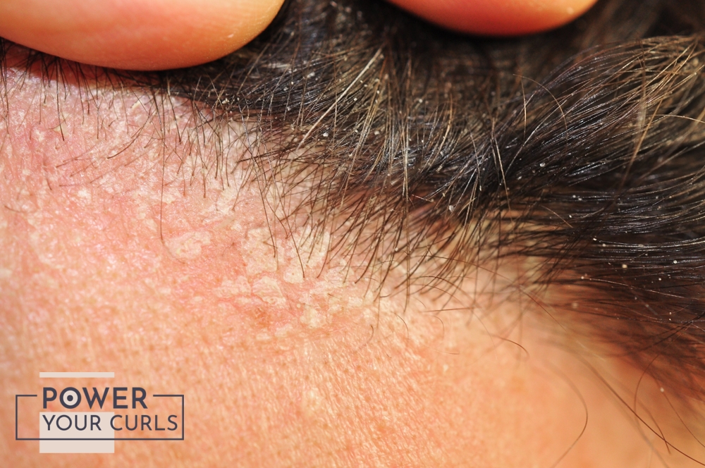 A close-up photo of a scalp with irritation and redness.