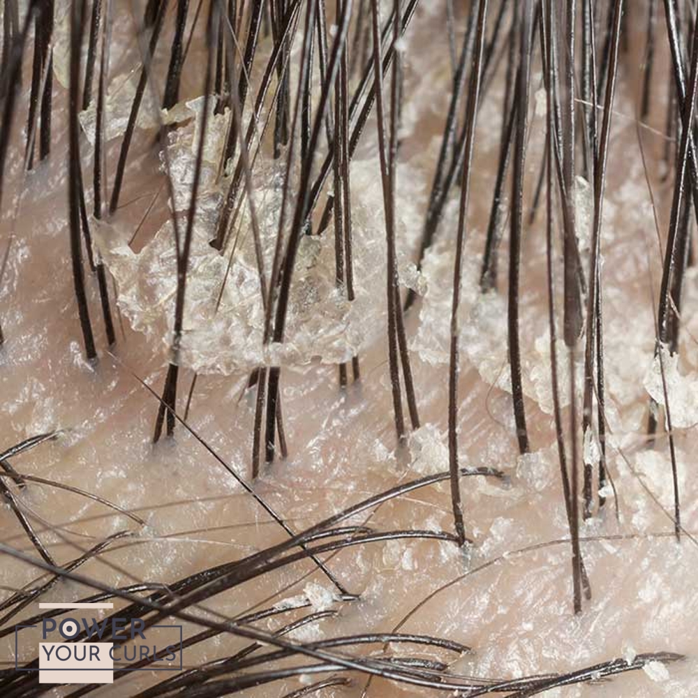 A close up photo of a scalp with oily dandruff.