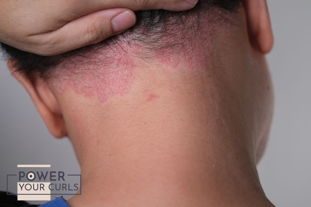 A photo of the back of a woman’s head, revealing redness and irritation.