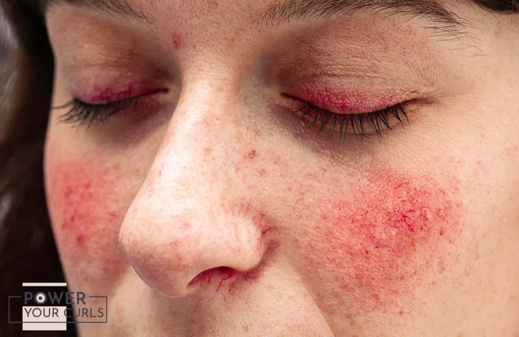 A photo of the skin condition "Rosacea"