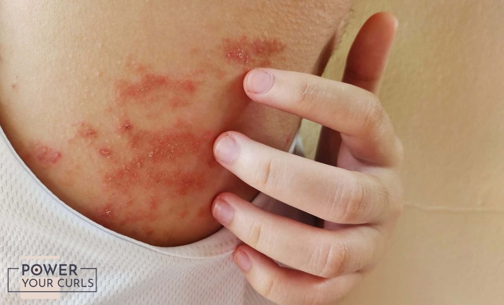 Eczema visible on a person's arm
