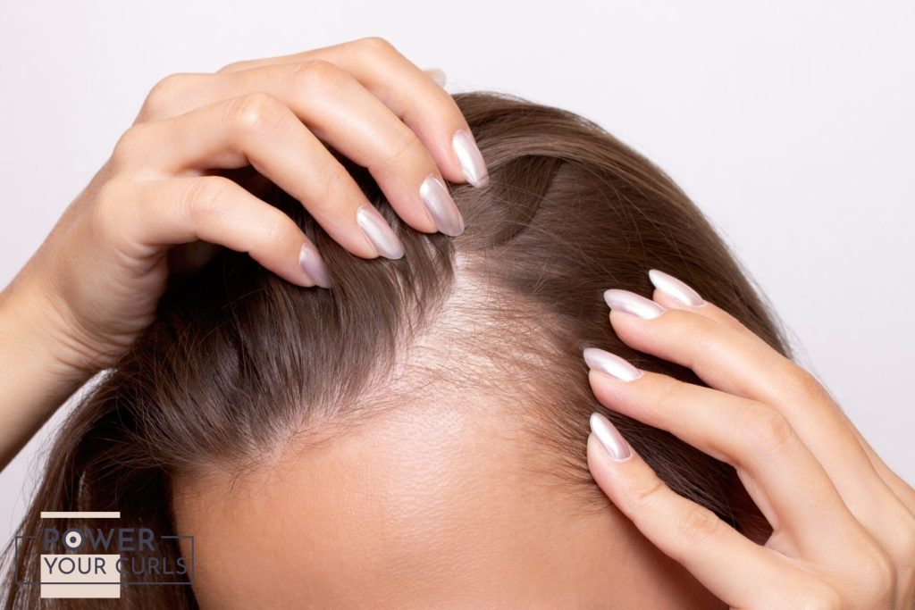 A close-up photo of a woman's scalp showing signs of hair thinning and a receding hairline.
