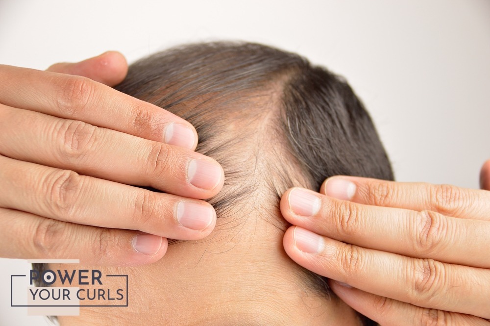 Six Effective Treatments For Hair Loss 5 A close-up photo of a man’s scalp showing a prominent receding hairline.