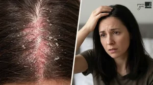 Home 13 Scalp Psoriasis And Body Image, Measured Against The Research (And What It Means For Curly Hair)